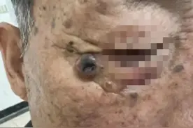 可怕！男子脸上习以为常的它一查竟是癌！和这个习惯有关图片