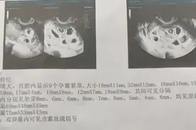 女子怀九胞胎，最终留下两胎图片