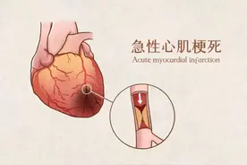 四年内一家三口先后突发心梗，医生：危险因素有家族聚集倾向图片