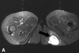 久坐一族注意啦，屁股上“长鸡蛋”可能是“坐骨结节囊肿”图片