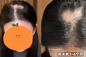 注射了50支……百万女网红变成“鬼剃头”！图片