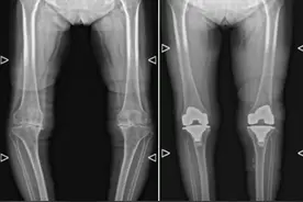 O型腿变直了 机器人辅助膝关节置换让患者重获行走自由图片