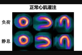 健康科普 | 带你了解心肌灌注显像图片
