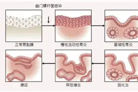浙江一家5口全中招，1人癌症！这种菌可能潜伏多年……图片