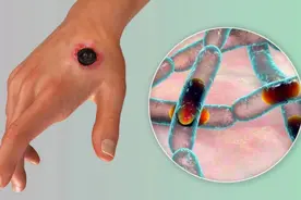 【汤医科普】山东发现炭疽病例！牛羊肉这么吃更安全图片