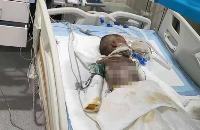 “一点火都看不见,就像一堆沙子……”3岁男童餐馆吃饭踩到炭火堆,全身85%烧伤!