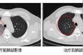 紧急提醒！确诊一例罕见传染病“Q热” 人畜共患图片