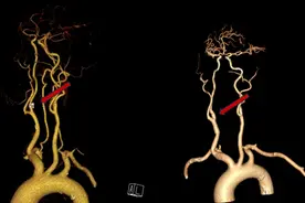 湘雅二医院血管外科率先在省内开展TCD监测下颈动脉内膜剥脱术图片