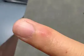 太崩溃！杭州网友：从头到脚长满冻疮，又肿又痒！医生提醒……图片