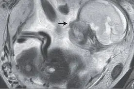 胎儿长在肠道内！法国37岁女子腹痛10天发现怀孕，29周诞下婴儿图片