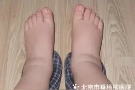 【杨柳科普】如何区分急性肾损伤和慢性肾病？一文说清关键点图片