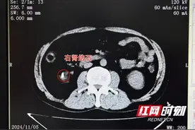 嗲嗲棋盘前一坐就是大半天 突发腰痛入院才知是结石作祟图片