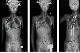11岁男孩脊柱侧弯120度，医生分次手术助其“挺直腰杆”图片