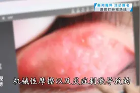 武汉小伙眼睛长出“鹅卵石”？医生提醒：春季多发图片