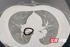 重症肺炎真凶竟为脱落的牙齿图片