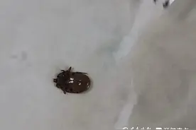 4岁娃头痒难忍，竟是蜱虫藏进头发！医生提醒：现在蜱虫叮咬高发图片