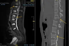 15岁男孩夜间梦游从6楼坠落多处爆裂骨折，如何保护梦游的孩子？图片