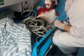 眼球内还有玻璃……被玻璃窗砸伤女孩已转入普通病房图片
