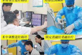 高龄肺结节手术难，微波消融助患者解“危局”图片