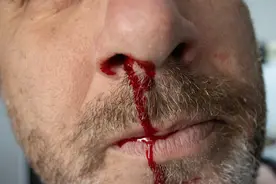 40岁男子口鼻狂喷鲜血！医生：原因多到你想不到图片