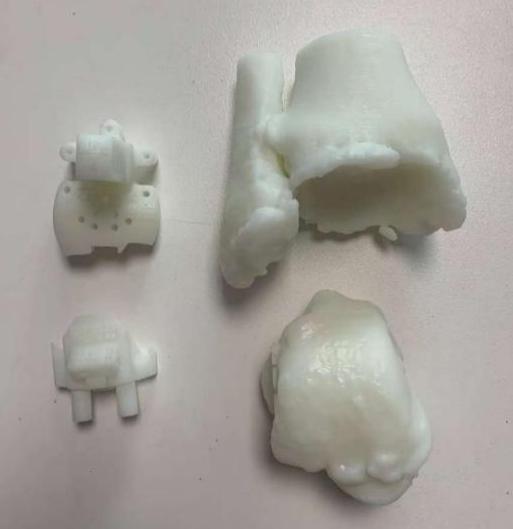 量“脚”定制！3D打印人工踝关节置换术为患者重塑“步履新生”