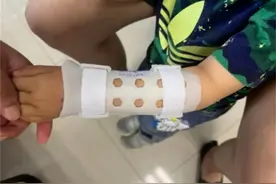 不手术治骨折！昆明市中医医院无痛正骨整复中心正式开诊图片