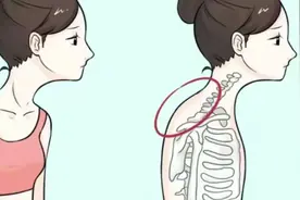 背颈部隆起、脖子前倾人群福利|本周末全国知名专家亲诊，一点微孔技术治疗“富贵包”！图片