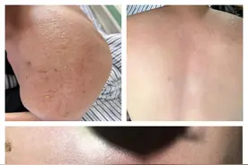 三伏天晒背导致“日晒伤”！专家提醒别盲目跟风图片