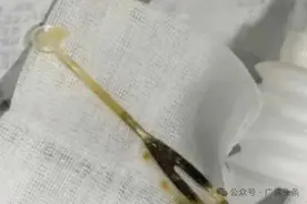 佛山男子肚子痛了3个月！百思不得其解！手术中发现：里面有把叉子……图片