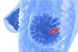 首个针对早期乳腺癌BRCA突变的靶向治疗药物在华获批图片