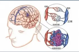 这个病“偏爱”年轻人，男子睡觉时突感剧烈头痛，送医后立即手术清理血肿！图片