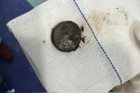 男童误吞纽扣电池医生紧急手术 仅2小时就把食道腐蚀出指甲盖大小黑痂图片