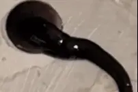 恐怖！年轻女子喉咙里藏了一条虫，医生“揪出”时还在动！图片