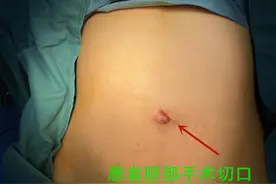 饮食无度阑尾反复发炎，“无痕”手术终结爱美女子腹痛图片