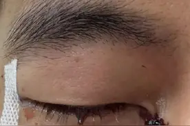 郭艾伦眼睛受伤缝了40多针！陶勇医生：结膜裂伤可以恢复到很好，不会影响运动生涯图片