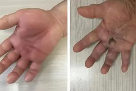 洗鱼时刺破手竟住院！医生提醒：染上这种细菌，严重时需截肢图片