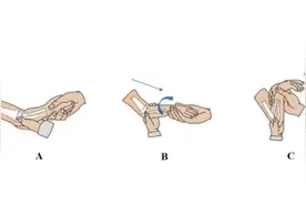 孩子经常胳膊“脱臼”，儿科医生教你三招复位图片