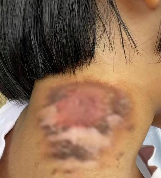 “河南多地现行走的硫酸”冲上热搜第一，河北山东等地网友表示中招！今年隐翅虫为何有点多？专家：或与这两个原因有关