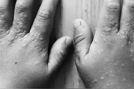 孩子手上小疙瘩 跟沙滩玩耍有关图片