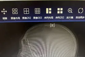 金山老人惨遭铁丝“穿”头，结果……图片