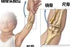 健康小站 | 牵牵衣角，宝宝手臂就疼，原来是桡骨小头半脱位了图片