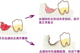 女子嘴里发出粪便般腐臭，原来是干槽症...图片