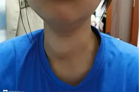 有医说医丨泉州13岁女孩颈部长出肿块，确诊甲状腺癌！图片