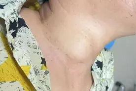 脖子右侧鼓包大如“鹌鹑蛋”，原来是常见的它！图片