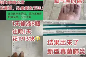闻了刚脱下的臭袜子，她竟感染真菌肺炎图片