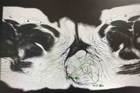 屁股长出肉“尾巴”，一查竟是肿瘤……图片