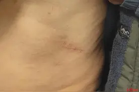 贵州一老人到精神病医院戒酒被打骨折，院方涉嫌让护士做假口供图片