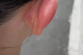 被蚊子咬后掐“十”字或涂口水能止痒吗？气温升高，这事你一定要知道图片