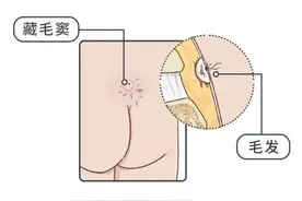 中学生每日久坐打游戏，屁股上长出肿包！久坐是该病好发因素图片