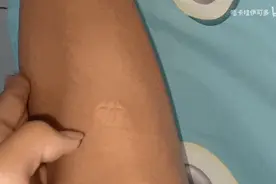 皮肤科医生才知道的止痒“神器”，门口药店只要十几块一瓶图片